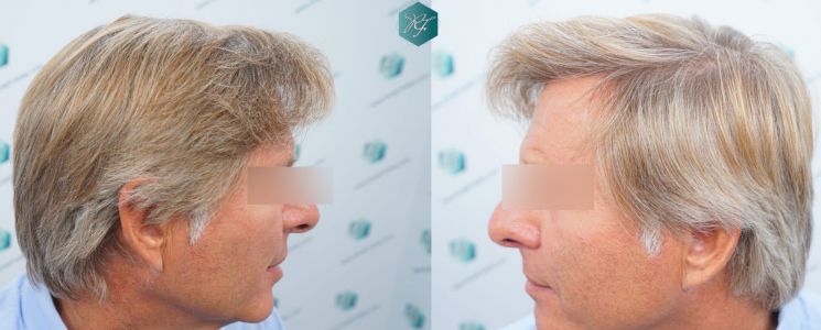 Injerto Capilar Técnica FUE Grafts 2942 (6642 Pelos) 43 45 COMPARATIVAS