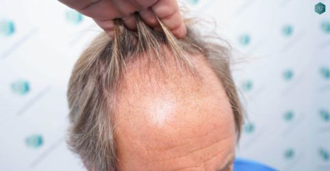 Injerto Capilar Técnica FUE Grafts 2942 (6642 Pelos) 7 5 ANTES DEL TRASPLANTE CAPILAR