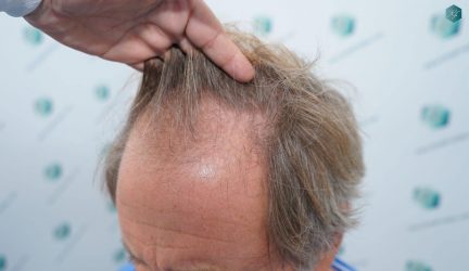 Injerto Capilar Técnica FUE Grafts 2942 (6642 Pelos) 8 6 ANTES DEL TRASPLANTE CAPILAR