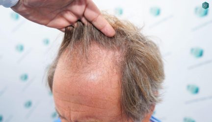 Injerto Capilar Técnica FUE Grafts 2942 (6642 Pelos) 9 7 ANTES DEL TRASPLANTE CAPILAR