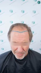 LÍNEA DISEÑO INJERTO CAPILAR 8 ANTES DEL TRASPLANTE CAPILAR