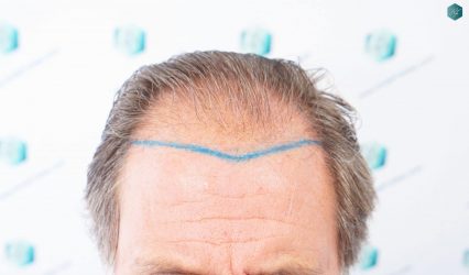 Injerto Capilar Técnica FUE Grafts 2942 (6642 Pelos) 12 9 ANTES DEL TRASPLANTE CAPILAR