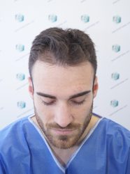 ANTES DEL TRASPLANTE CAPILAR 1 ANTES TRASPLANTE CAPILAR 1