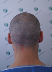 Injerto Capilar Técnica FUE Grafts 2271 (6310 Pelos) 8 10 DISENO LINEA INJERTO 10