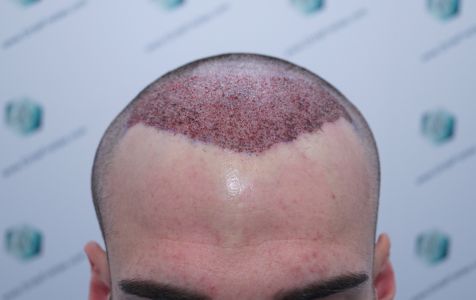 Injerto Capilar Técnica FUE Grafts 2271 (6310 Pelos) 9 12 TRASPLANTE CAPILAR 12