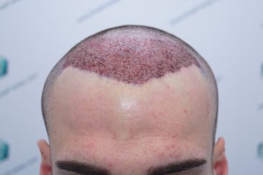 Injerto Capilar Técnica FUE Grafts 2271 (6310 Pelos) 10 13 TRASPLANTE CAPILAR 13