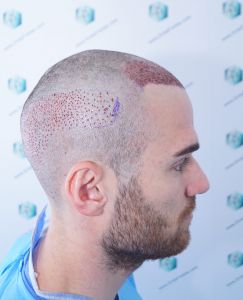 Injerto Capilar Técnica FUE Grafts 2271 (6310 Pelos) 11 14 TRASPLANTE CAPILAR 14