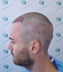 Injerto Capilar Técnica FUE Grafts 2271 (6310 Pelos) 12 15 TRASPLANTE CAPILAR 15