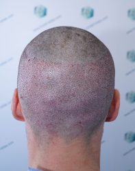 Injerto Capilar Técnica FUE Grafts 2271 (6310 Pelos) 13 16 TRASPLANTE CAPILAR 16