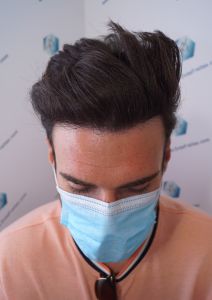 Injerto Capilar Técnica FUE Grafts 2271 (6310 Pelos) 14 18 RESULTADOS TRASPLANTE CAPILAR 9 MESES 17