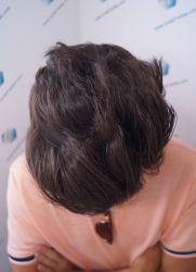 Injerto Capilar Técnica FUE Grafts 2271 (6310 Pelos) 15 18A RESULTADOS TRASPLANTE CAPILAR 9 MESES 18