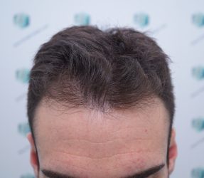 Injerto Capilar Técnica FUE Grafts 2271 (6310 Pelos) 1 2 ANTES TRASPLANTE CAPILAR 2