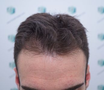 Injerto Capilar Técnica FUE Grafts 2271 (6310 Pelos) 1 2 ANTES TRASPLANTE CAPILAR 2