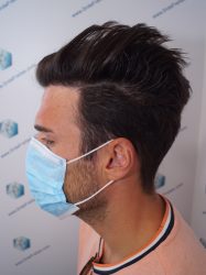 Injerto Capilar Técnica FUE Grafts 2271 (6310 Pelos) 17 20 RESULTADOS TRASPLANTE CAPILAR 9 MESES 20