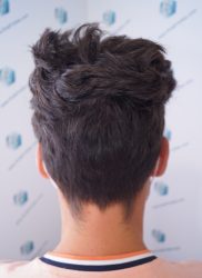 Injerto Capilar Técnica FUE Grafts 2271 (6310 Pelos) 18 21 RESULTADOS TRASPLANTE CAPILAR 9 MESES 21