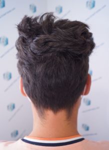 Injerto Capilar Técnica FUE Grafts 2271 (6310 Pelos) 18 21 RESULTADOS TRASPLANTE CAPILAR 9 MESES 21