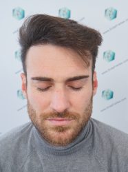 RESULTADOS A LOS 12 MESES 22 RESULTADOS TRASPLANTE CAPILAR 12 MESES 17