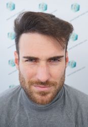 22 RESULTADOS TRASPLANTE CAPILAR 12 MESES 18 22 RESULTADOS TRASPLANTE CAPILAR 12 MESES 18