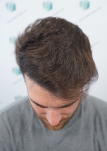 Injerto Capilar Técnica FUE Grafts 2271 (6310 Pelos) 20 23 RESULTADOS TRASPLANTE CAPILAR 12 MESES 19