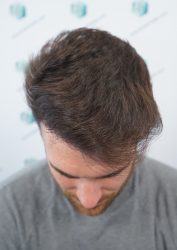 Injerto Capilar Técnica FUE Grafts 2271 (6310 Pelos) 19 23 RESULTADOS TRASPLANTE CAPILAR 12 MESES 19