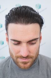 Injerto Capilar Técnica FUE Grafts 2271 (6310 Pelos) 20 24 RESULTADOS TRASPLANTE CAPILAR 12 MESES 20