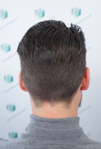 Injerto Capilar Técnica FUE Grafts 2271 (6310 Pelos) 24 27 RESULTADOS TRASPLANTE CAPILAR 12 MESES 23