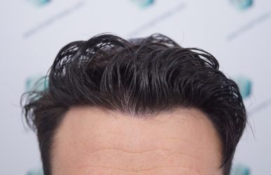 Injerto Capilar Técnica FUE Grafts 2271 (6310 Pelos) 21 28 RESULTADOS TRASPLANTE CAPILAR 12 MESES 24