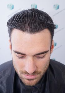 Injerto Capilar Técnica FUE Grafts 2271 (6310 Pelos) 26 29 RESULTADOS TRASPLANTE CAPILAR 12 MESES 25