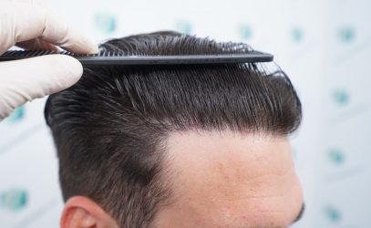 30 RESULTADOS TRASPLANTE CAPILAR 12 MESES 26 30 RESULTADOS TRASPLANTE CAPILAR 12 MESES 26