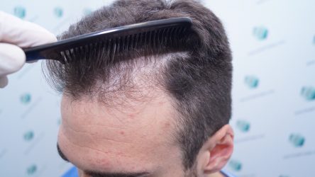 Injerto Capilar Técnica FUE Grafts 2271 (6310 Pelos) 3 4 ANTES TRASPLANTE CAPILAR 4