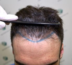 DISENO LINEA INJERTO 5 DISENO LINEA INJERTO 5