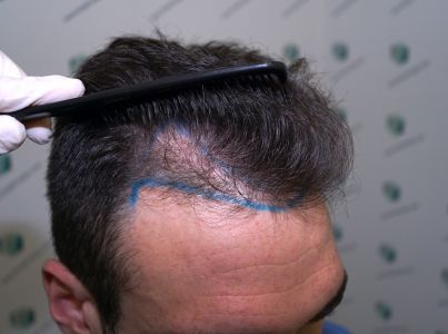 Injerto Capilar Técnica FUE Grafts 2271 (6310 Pelos) 4 6 DISENO LINEA INJERTO 6