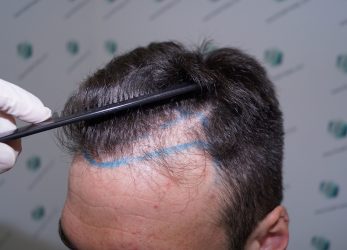 Injerto Capilar Técnica FUE Grafts 2271 (6310 Pelos) 5 7 DISENO LINEA INJERTO 7