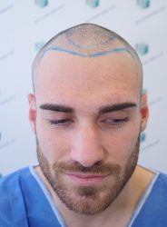 Injerto Capilar Técnica FUE Grafts 2271 (6310 Pelos) 6 8 DISENO LINEA INJERTO 8