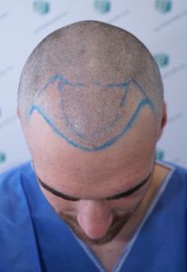 Injerto Capilar Técnica FUE Grafts 2271 (6310 Pelos) 7 9 DISENO LINEA INJERTO 9