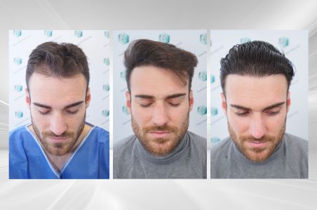 Injerto Capilar Técnica FUE Grafts 2271 (6310 Pelos) 29 X COMPARATIVAS 1