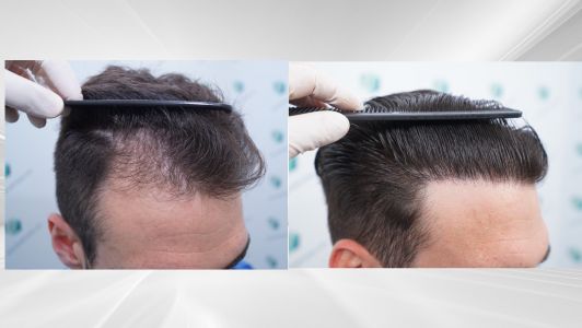 Injerto Capilar Técnica FUE Grafts 2271 (6310 Pelos) 30 X COMPARATIVAS 2