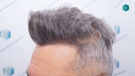 Injerto Capilar Técnica FUE Grafts 3712 (7455 Pelos) 89 100 RESULTADOS A LOS 12 MESES