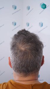 Injerto Capilar Técnica FUE Grafts 3712 (7455 Pelos) 90 101 RESULTADOS A LOS 12 MESES