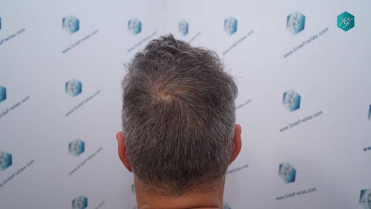 Injerto Capilar Técnica FUE Grafts 3712 (7455 Pelos) 91 102 RESULTADOS A LOS 12 MESES