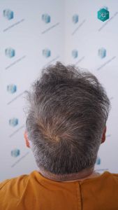 Injerto Capilar Técnica FUE Grafts 3712 (7455 Pelos) 92 103 RESULTADOS A LOS 12 MESES