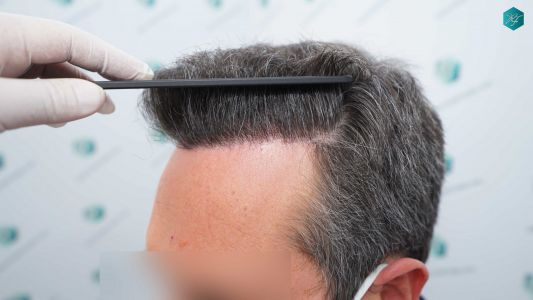 Injerto Capilar Técnica FUE Grafts 3289 (8464 Pelos) 29 104 12 MESES EVOLUCION
