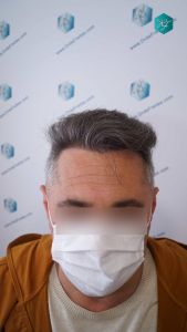 Injerto Capilar Técnica FUE Grafts 3712 (7455 Pelos) 94 105 RESULTADOS A LOS 12 MESES