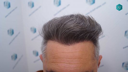 Injerto Capilar Técnica FUE Grafts 3712 (7455 Pelos) 95 105A RESULTADOS A LOS 12 MESES