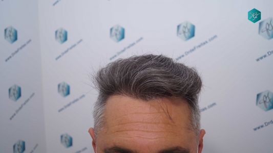 Injerto Capilar Técnica FUE Grafts 3712 (7455 Pelos) 96 106 RESULTADOS A LOS 12 MESES
