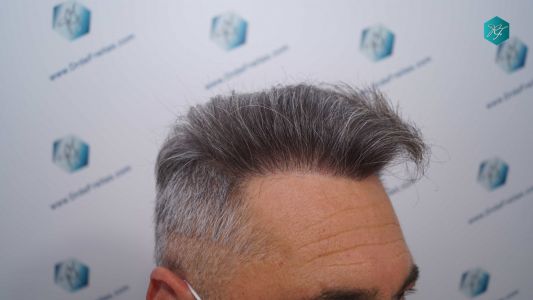 Injerto Capilar Técnica FUE Grafts 3712 (7455 Pelos) 97 108 RESULTADOS A LOS 12 MESES