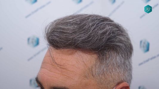 Injerto Capilar Técnica FUE Grafts 3712 (7455 Pelos) 98 108B RESULTADOS A LOS 12 MESES