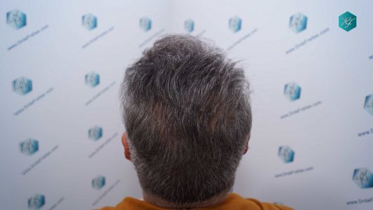 Injerto Capilar Técnica FUE Grafts 3712 (7455 Pelos) 99 110 RESULTADOS A LOS 12 MESES