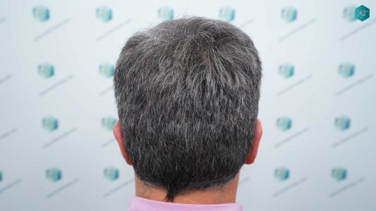 Injerto Capilar Técnica FUE Grafts 3289 (8464 Pelos) 30 110B 12 MESES EVOLUCION