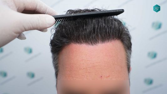 Injerto Capilar Técnica FUE Grafts 3289 (8464 Pelos) 31 111 12 MESES EVOLUCION